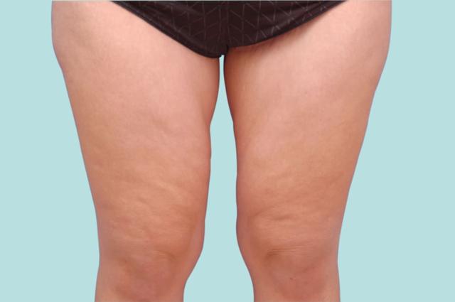 Thigh Lift after at Los Angeles Plastic Surgery in Beverly Hills, CA