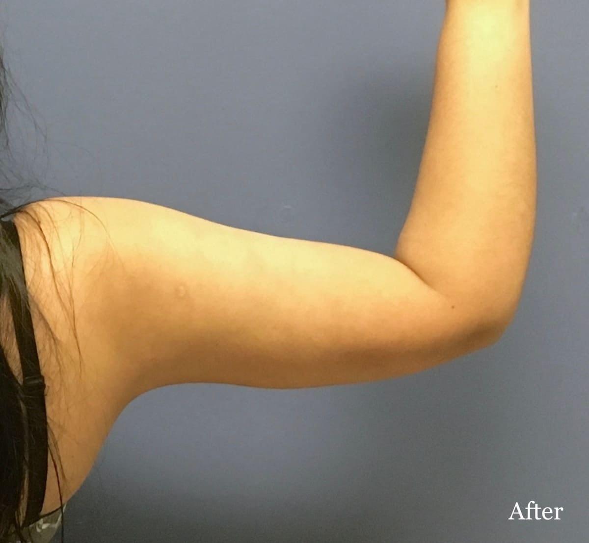 Los Angeles Plastic Surgery liposuction after — Beverly Hills, CA