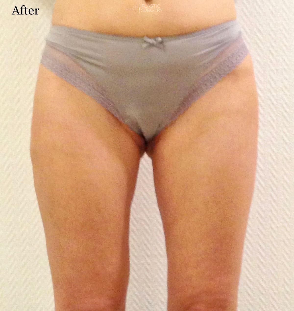 Los Angeles Plastic Surgery liposuction after — Beverly Hills, CA