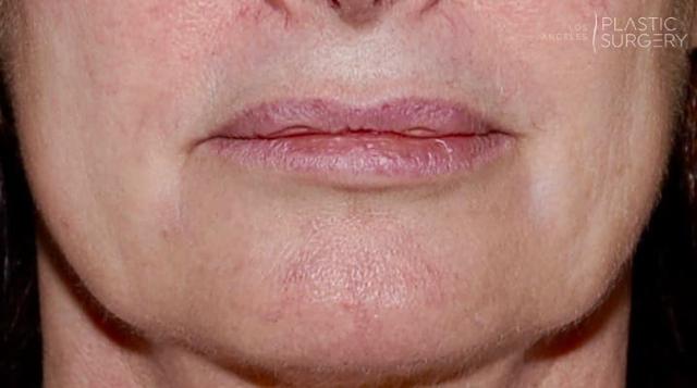Fat Transfer before at Los Angeles Plastic Surgery in Beverly Hills, CA