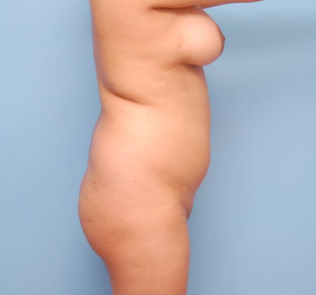 Brazilian Butt Lift before at Los Angeles Plastic Surgery in Beverly Hills, CA