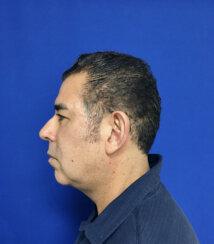Rhinoplasty before at Los Angeles Plastic Surgery in Beverly Hills, CA