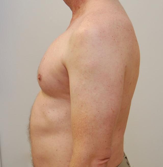 Thigh Lift after at Los Angeles Plastic Surgery in Beverly Hills, CA