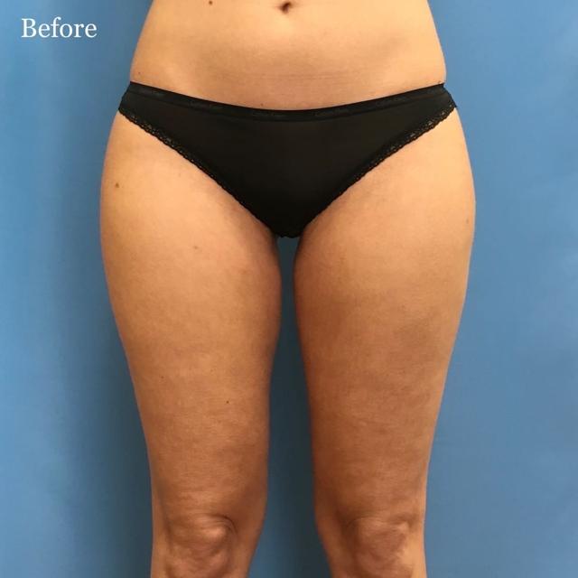 Liposuction before at Los Angeles Plastic Surgery in Beverly Hills, CA