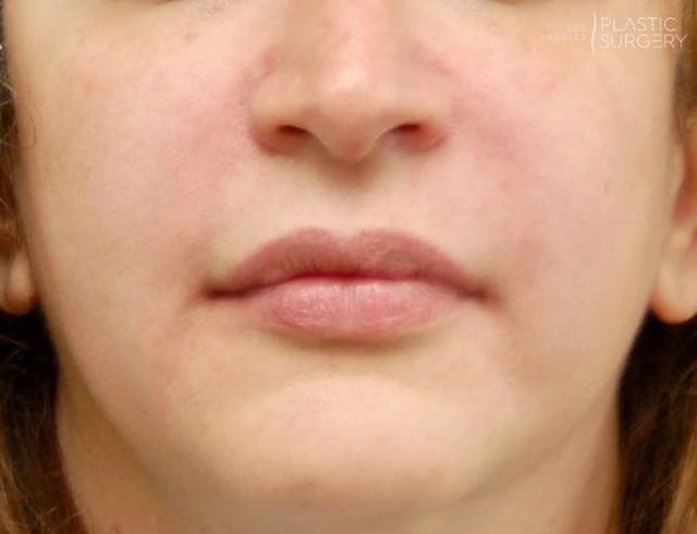 Lip Filler after at Los Angeles Plastic Surgery in Beverly Hills, CA