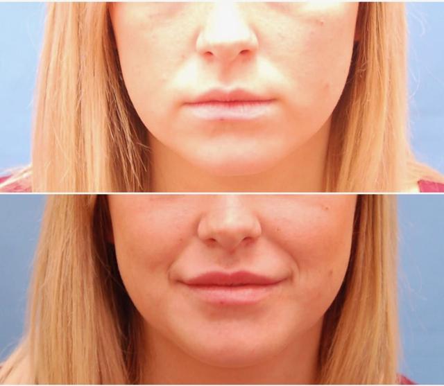 Lip Filler result at Los Angeles Plastic Surgery in Beverly Hills, CA