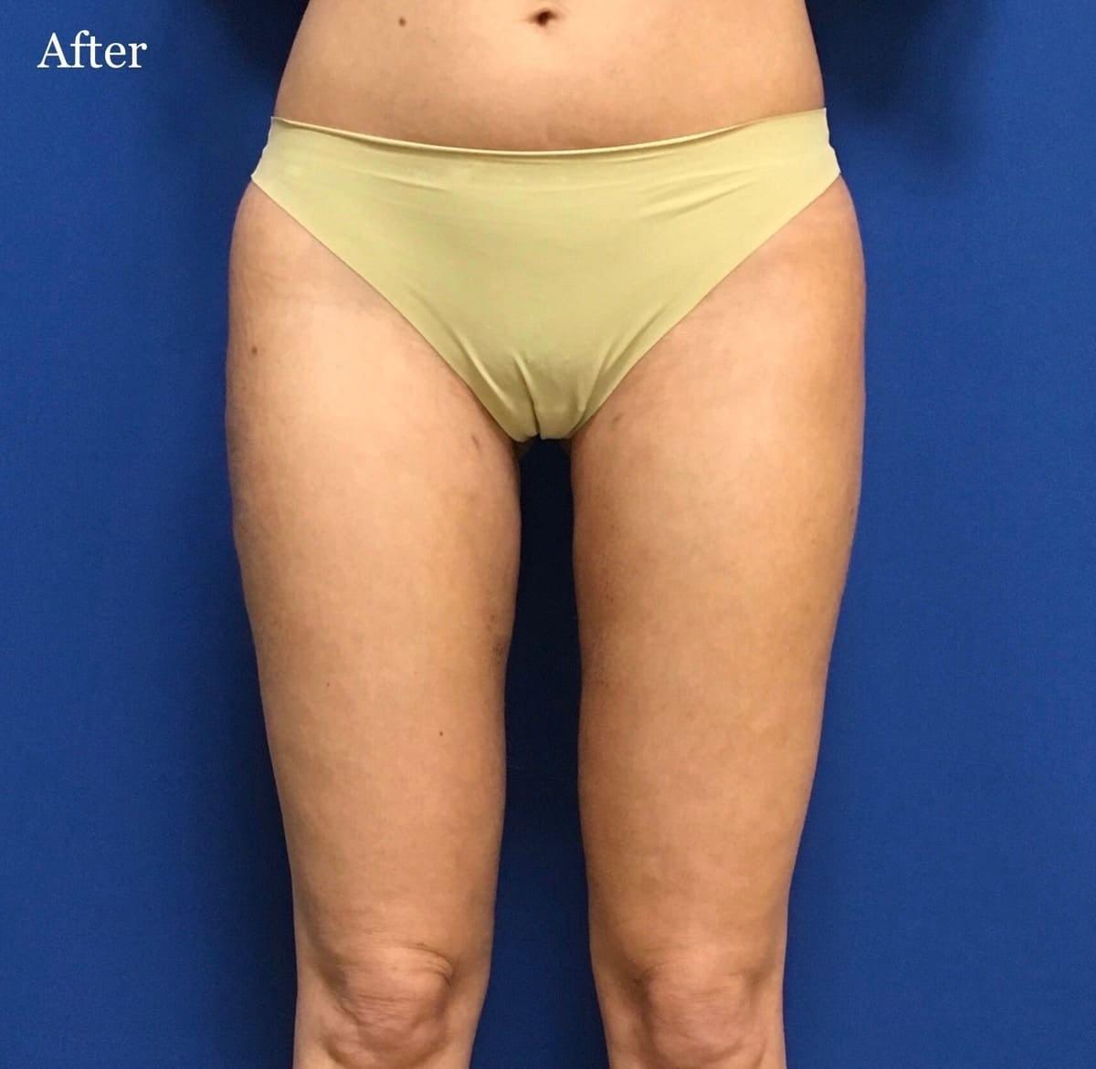 Los Angeles Plastic Surgery liposuction after — Beverly Hills, CA