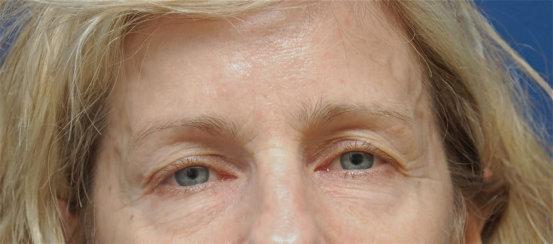 Los Angeles Plastic Surgery result — Beverly Hills, CA