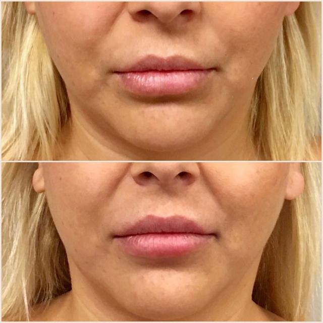 Lip Filler result at Los Angeles Plastic Surgery in Beverly Hills, CA