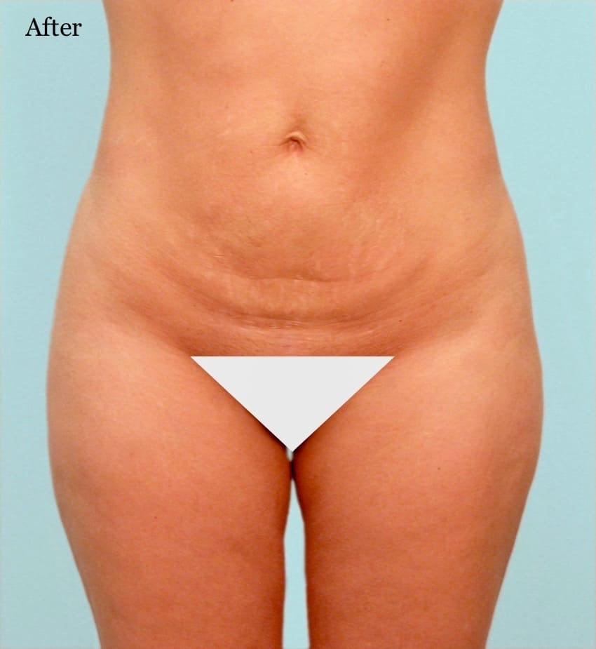 Los Angeles Plastic Surgery liposuction after — Beverly Hills, CA