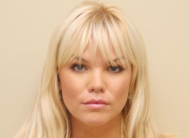 Lip Filler after at Los Angeles Plastic Surgery in Beverly Hills, CA