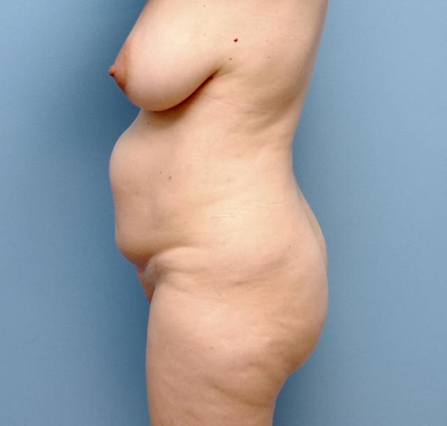 Mini Tummy Tuck before at Los Angeles Plastic Surgery in Beverly Hills, CA
