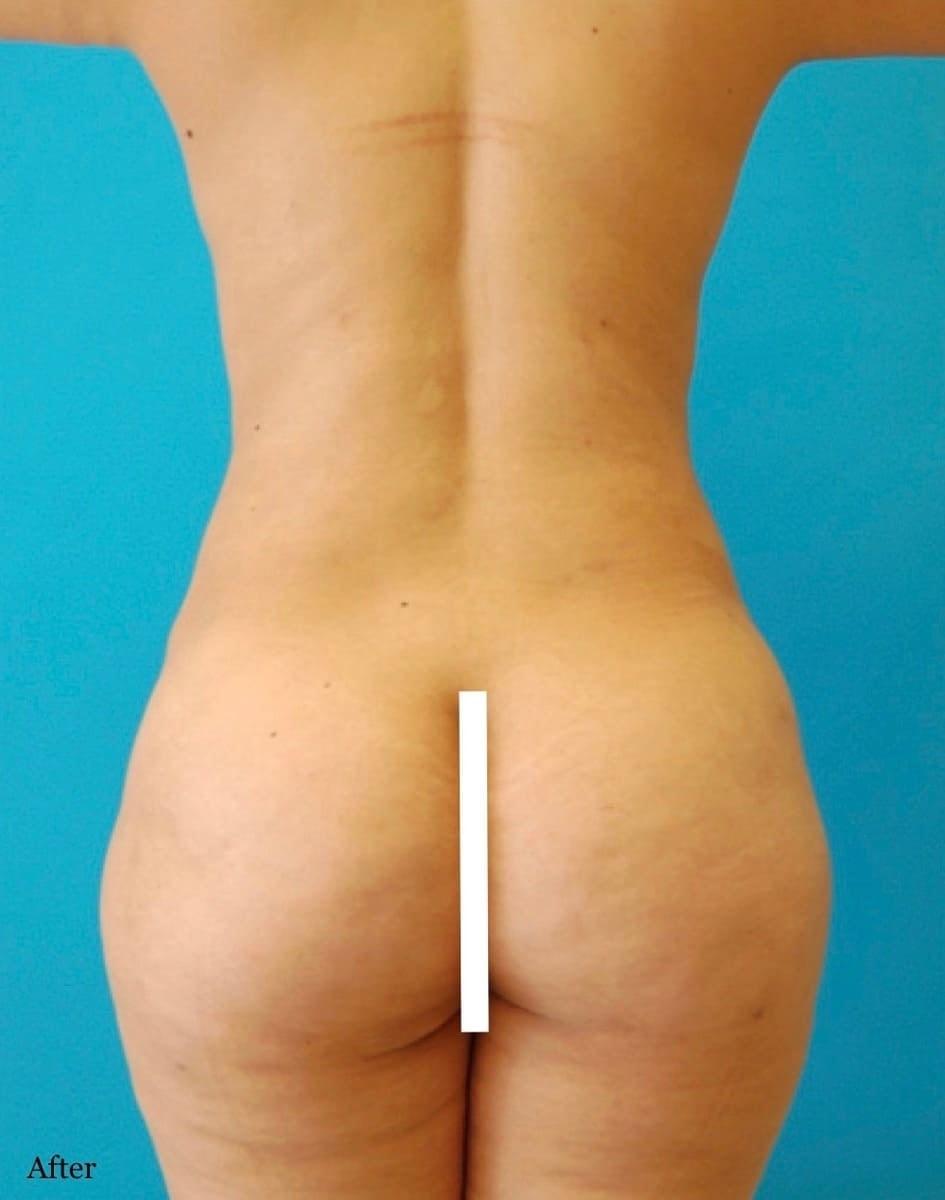 Los Angeles Plastic Surgery bbl after — Beverly Hills, CA
