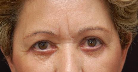 Los Angeles Plastic Surgery result — Beverly Hills, CA