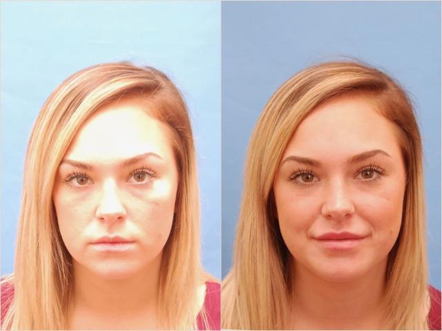 Lip Filler result at Los Angeles Plastic Surgery in Beverly Hills, CA