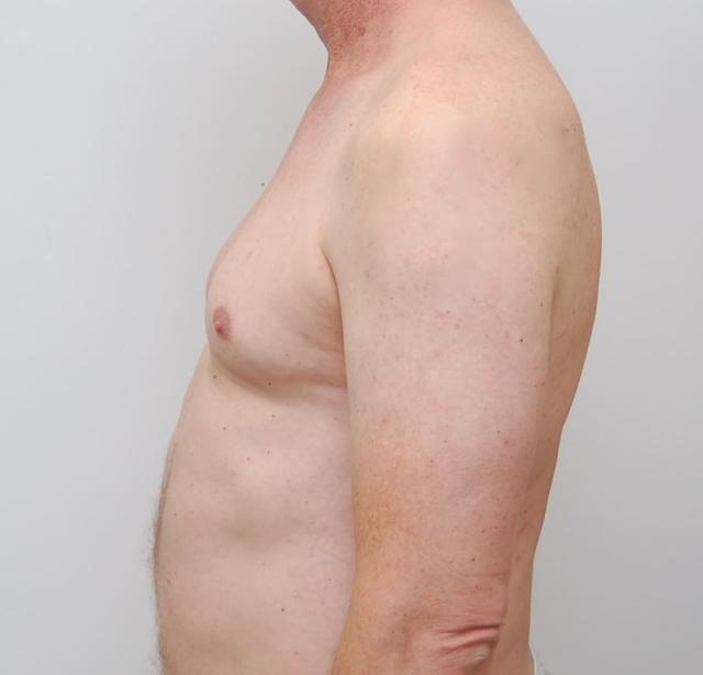 Thigh Lift before at Los Angeles Plastic Surgery in Beverly Hills, CA