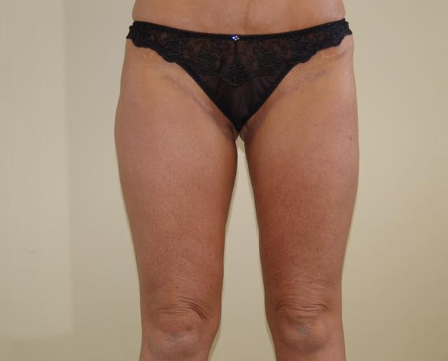 Thigh Lift after at Los Angeles Plastic Surgery in Beverly Hills, CA