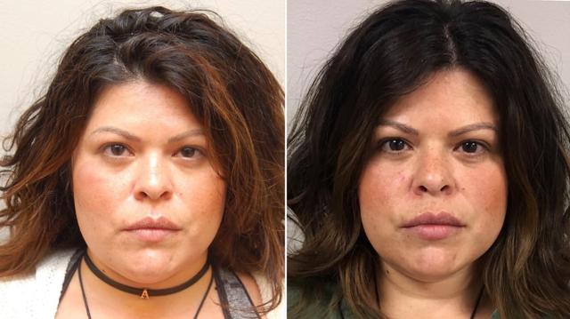 Lip Filler result at Los Angeles Plastic Surgery in Beverly Hills, CA