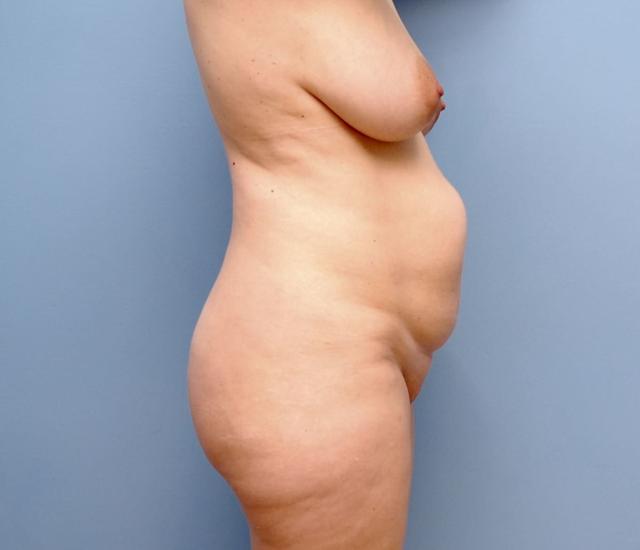 Mini Tummy Tuck before at Los Angeles Plastic Surgery in Beverly Hills, CA