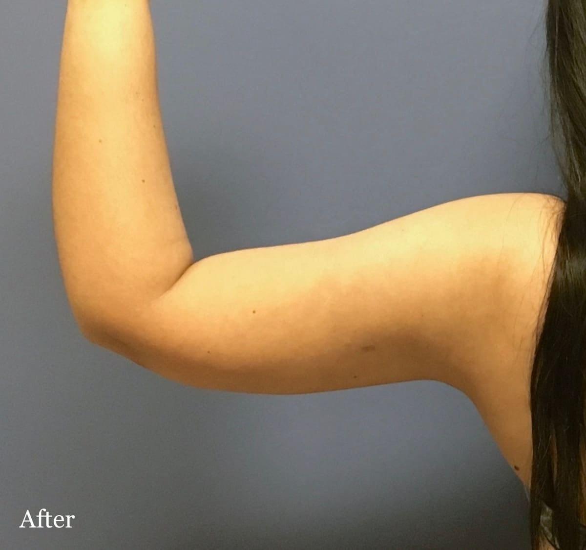Los Angeles Plastic Surgery liposuction after — Beverly Hills, CA