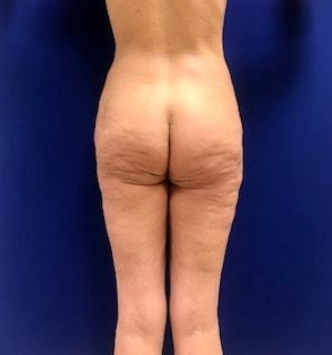 Thigh Lift before at Los Angeles Plastic Surgery in Beverly Hills, CA