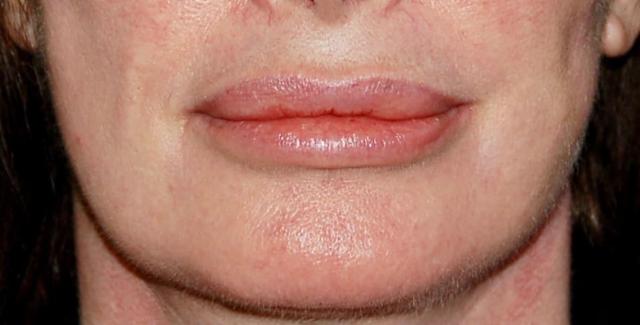 Fat Transfer after at Los Angeles Plastic Surgery in Beverly Hills, CA