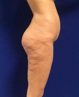 Thigh Lift before at Los Angeles Plastic Surgery in Beverly Hills, CA