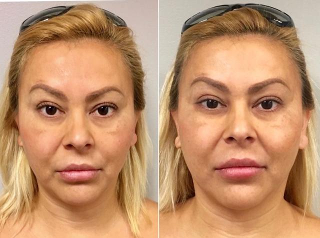 Lip Filler result at Los Angeles Plastic Surgery in Beverly Hills, CA