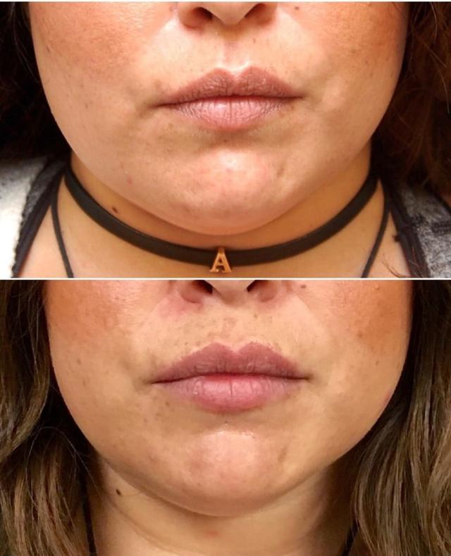 Lip Filler result at Los Angeles Plastic Surgery in Beverly Hills, CA