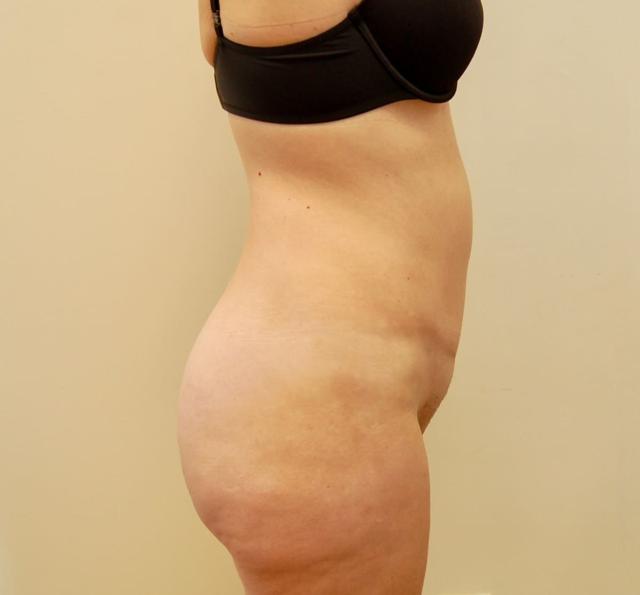 Mini Tummy Tuck after at Los Angeles Plastic Surgery in Beverly Hills, CA