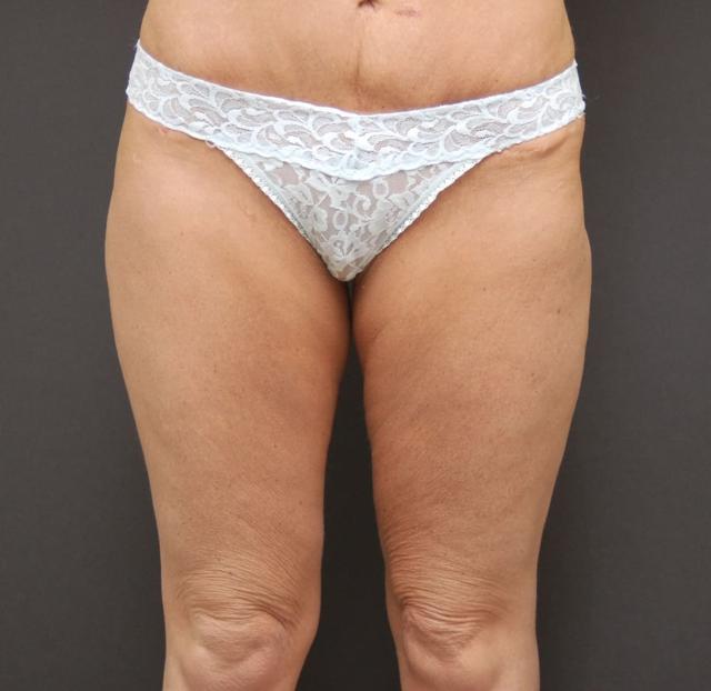Thigh Lift before at Los Angeles Plastic Surgery in Beverly Hills, CA