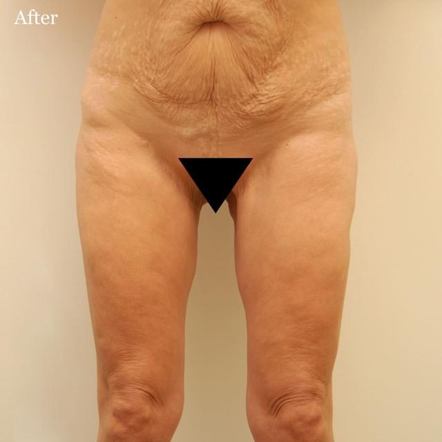 Thigh Lift after at Los Angeles Plastic Surgery in Beverly Hills, CA