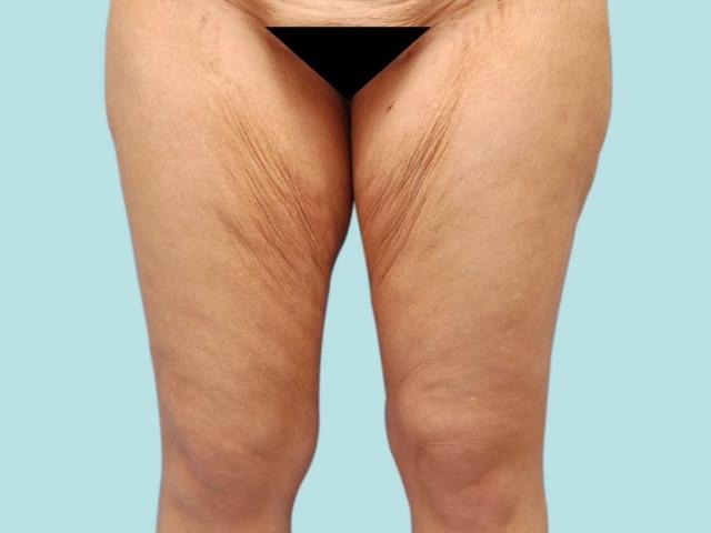 Thigh Lift before at Los Angeles Plastic Surgery in Beverly Hills, CA