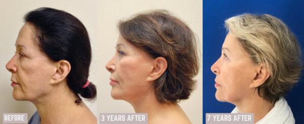 Los Angeles Plastic Surgery result — Beverly Hills, CA