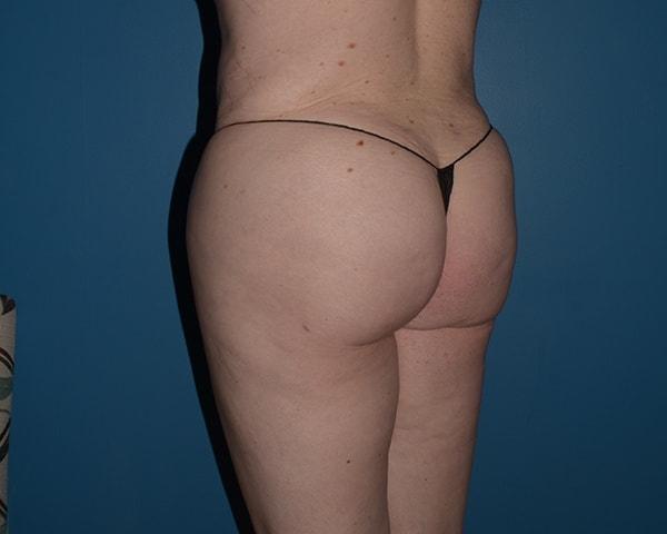 Brazilian Butt Lift after at RP Plastic Surgery in Bellevue, WA