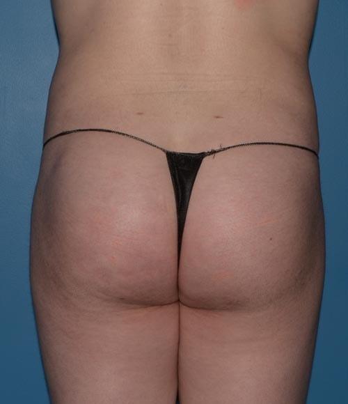 Brazilian Butt Lift after at RP Plastic Surgery in Bellevue, WA