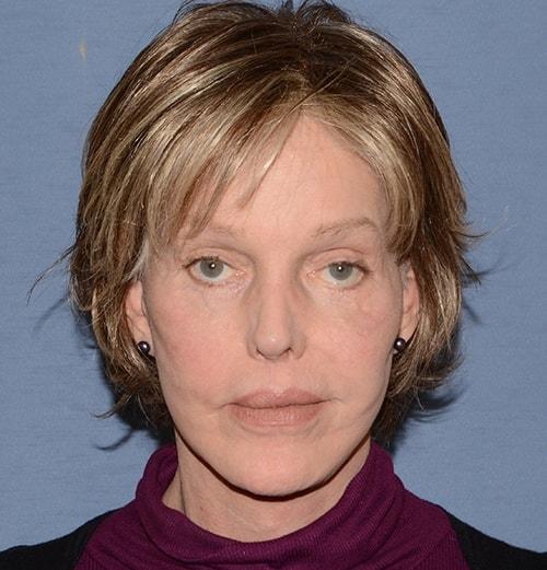 Deep Plane Facelift after at RP Plastic Surgery in Bellevue, WA