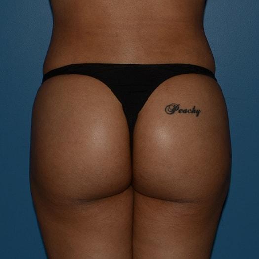 Brazilian Butt Lift after at RP Plastic Surgery in Bellevue, WA