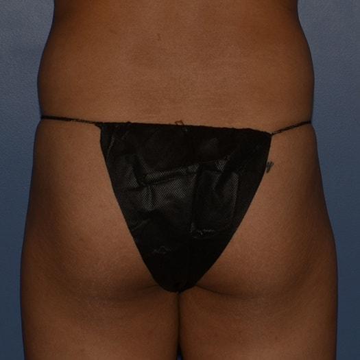 Brazilian Butt Lift before at RP Plastic Surgery in Bellevue, WA
