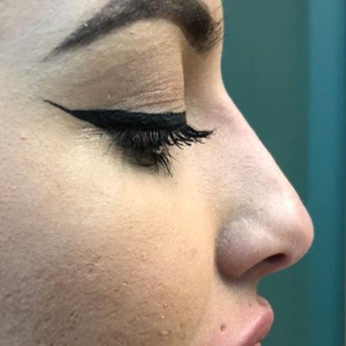 Liquid Rhinoplasty after at RP Plastic Surgery in Bellevue, WA