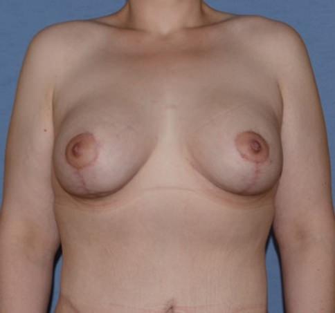 RP Plastic Surgery breast lift after — Bellevue, WA