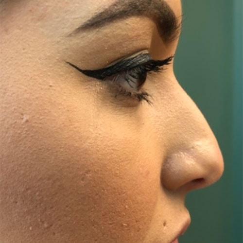 Liquid Rhinoplasty before at RP Plastic Surgery in Bellevue, WA