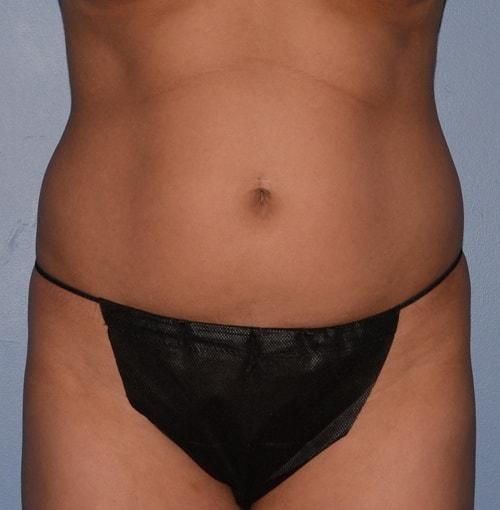 Liposuction before at RP Plastic Surgery in Bellevue, WA
