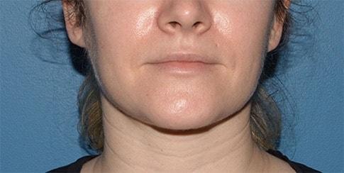 Neck Liposuction after at RP Plastic Surgery in Bellevue, WA