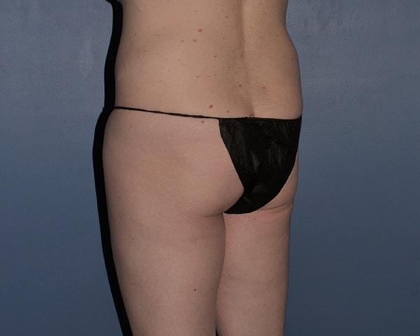 Brazilian Butt Lift before at RP Plastic Surgery in Bellevue, WA