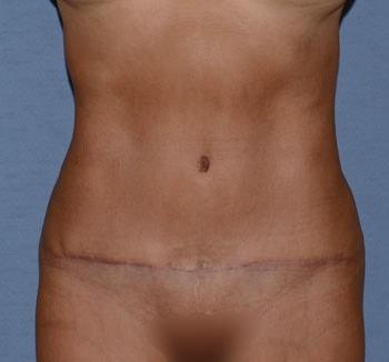 RP Plastic Surgery tummy tuck after — Bellevue, WA