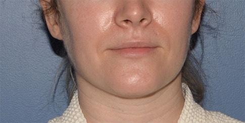 Neck Liposuction before at RP Plastic Surgery in Bellevue, WA