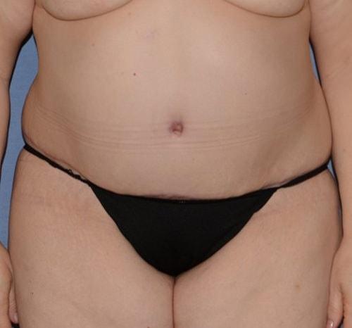 RP Plastic Surgery tummy tuck after — Bellevue, WA