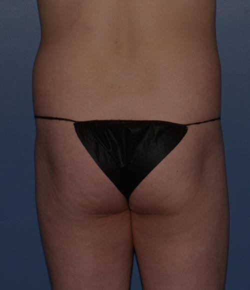 Brazilian Butt Lift before at RP Plastic Surgery in Bellevue, WA