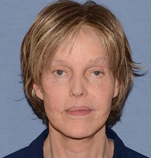 Deep Plane Facelift before at RP Plastic Surgery in Bellevue, WA